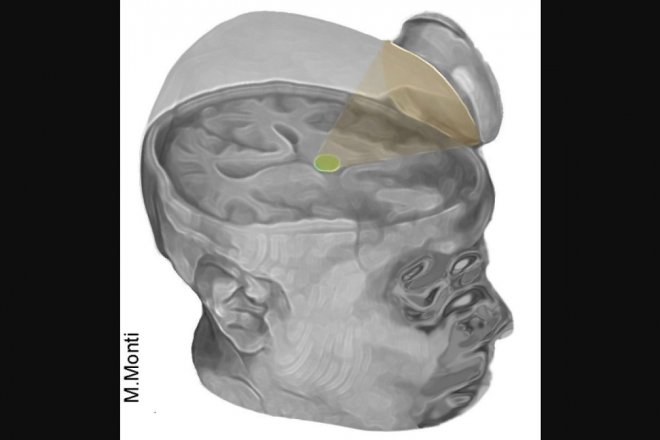 Еще двух пациентов удалось вывести из&nbsp;комы при помощи ультразвука 