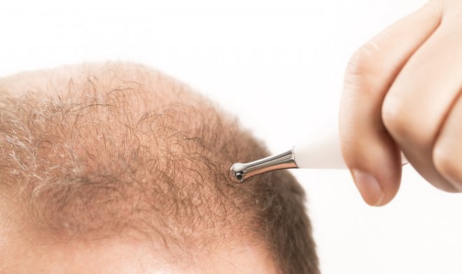 Одной из ключевых причин облысения оказался несбалансированный процесс деления клеток