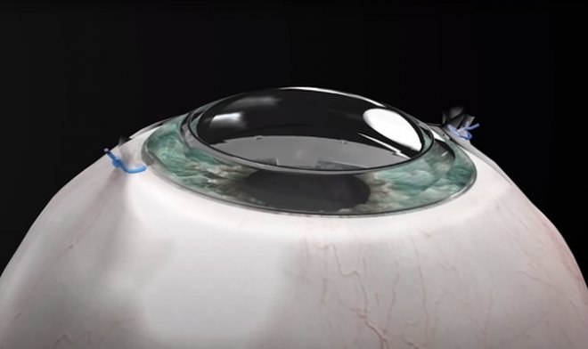 Синтетическая роговица CorNeat вернула зрение слепому пациенту 