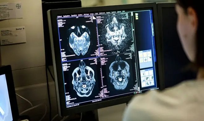 Коронавирус способен серьезно повреждать головной мозг