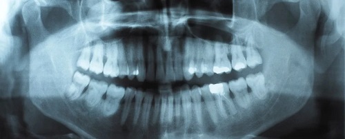 Скрежещете зубами? Вот почему и что вы можете с этим сделать