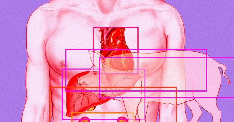 Человек которому пересадили свиное сердце оказался рецидивистом