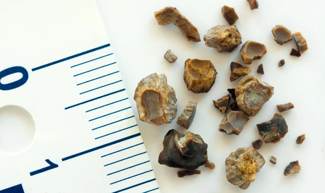 Новое звуковолновое устройство позволит разрушать камни в почках без операции 