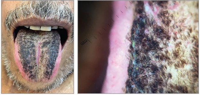 После перенесенного инсульта язык мужчины из Индии стал черным и мохнатым