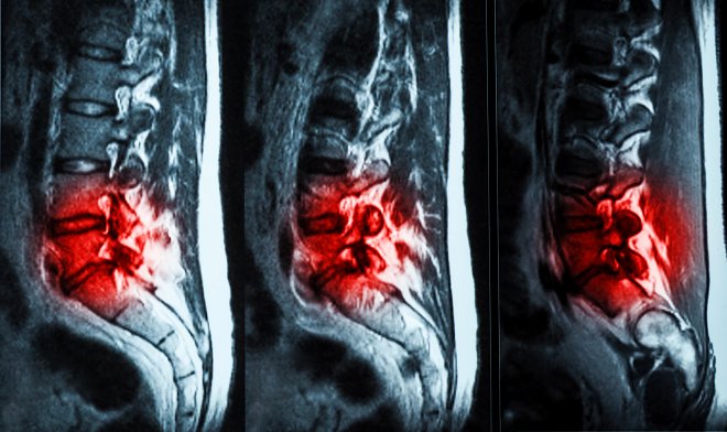 Инъекционный гидрогель эффективно избавит от болей в пояснице 