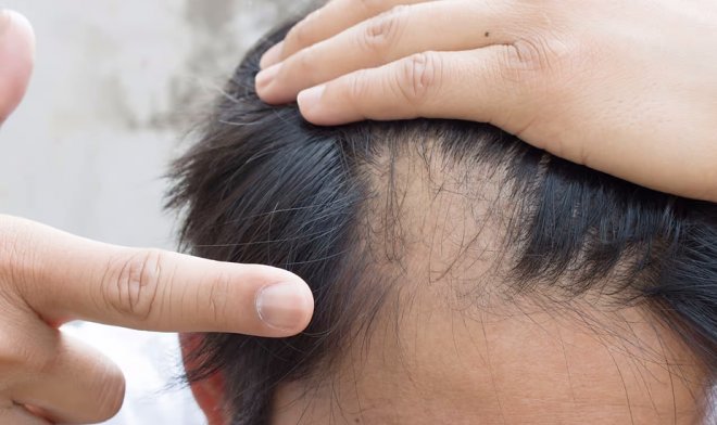 В США официально одобрили первое в&nbsp;своем роде лекарство от облысения 