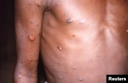 Вспышку оспы обезьян глава ВОЗ объявил чрезвычайной ситуацией