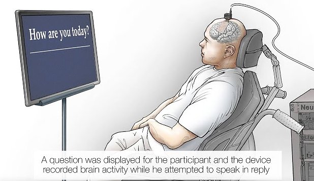 Нейроимплант поможет немому человеку общаться с окружающими при помощи мысли