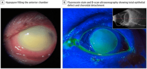 В США растет число погибших от глазных капель, зараженных синегнойной палочкой