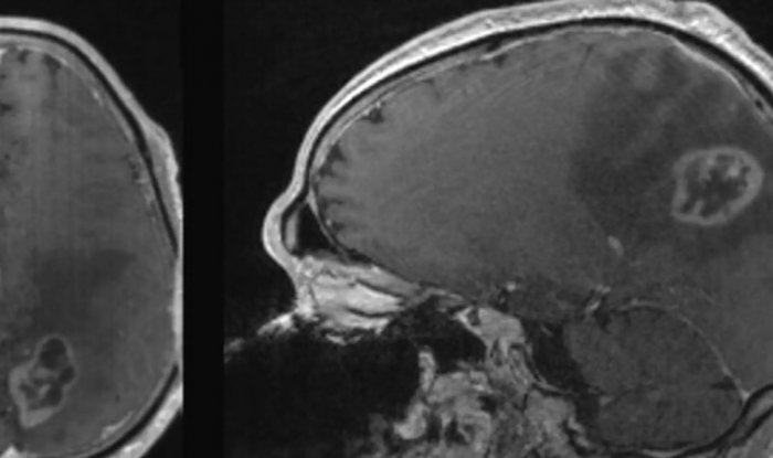 Особая диета запускает в раковых клетках механизм самоуничтожения