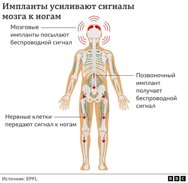 В Швейцарии парализованному мужчине вживили импланты в мозг и позвоночник. Теперь он снова может ходить