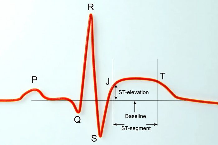 Никто не знает почему, но больше всего инфарктов происходит в понедельник