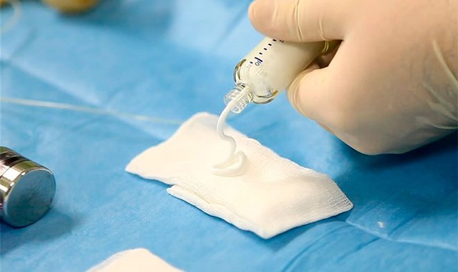 Российские ученые значительно улучшили состав &laquo;костного цемента&raquo;