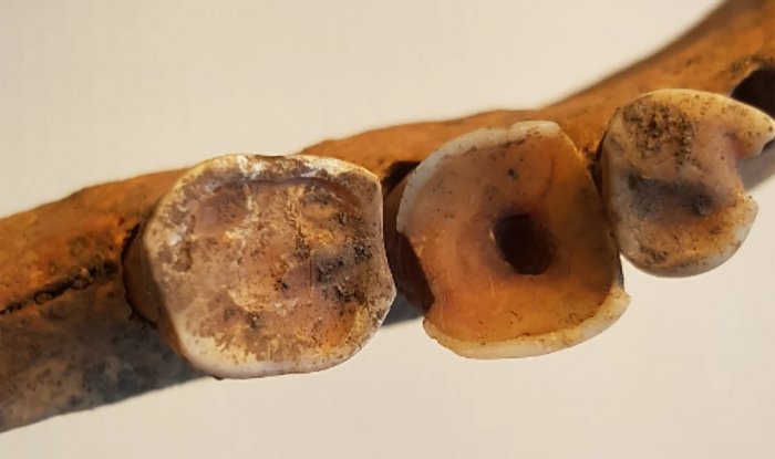 Доказано, что древние викинги были на удивление умелыми стоматологами