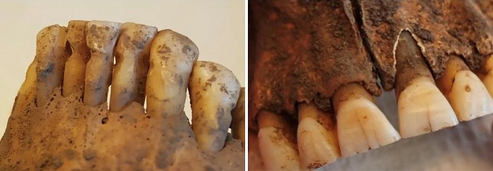 Доказано, что древние викинги были на удивление умелыми стоматологами