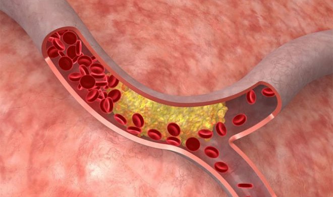 В Новосибирске создан полимер, предотвращающий разрывы сосудов