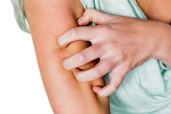 Ученые нашли неожиданную пользу в расчесывании укусов насекомых