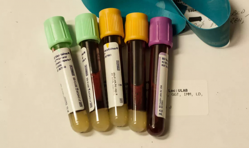 В Стэнфорде разработали анализ крови для определения скорости старения отдельных органов