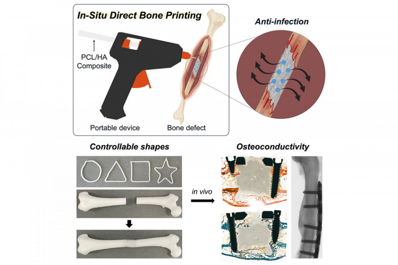 Клеевой пистолет позволит печатать заплатки для сломанных костей прямо во время операции