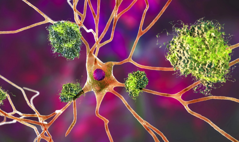 Белок-«виновник» Альцгеймера подзаряжает иммунные клетки и резко снижает риск рака