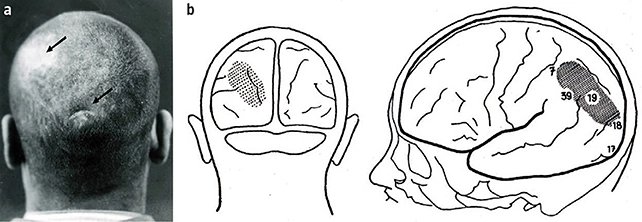 После огнестрельного ранения головы &laquo;пациент М&raquo; начал видеть мир наоборот