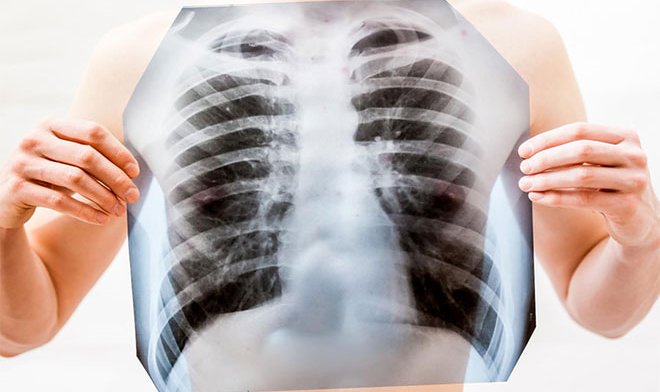 В &laquo;Сколтехе&raquo; обучили нейросеть обрабатывать рентген-снимки легких и ставить диагноз