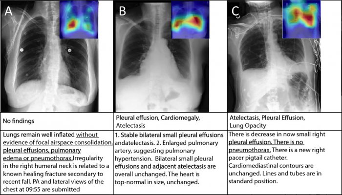 В &laquo;Сколтехе&raquo; обучили нейросеть обрабатывать рентген-снимки легких и ставить диагноз